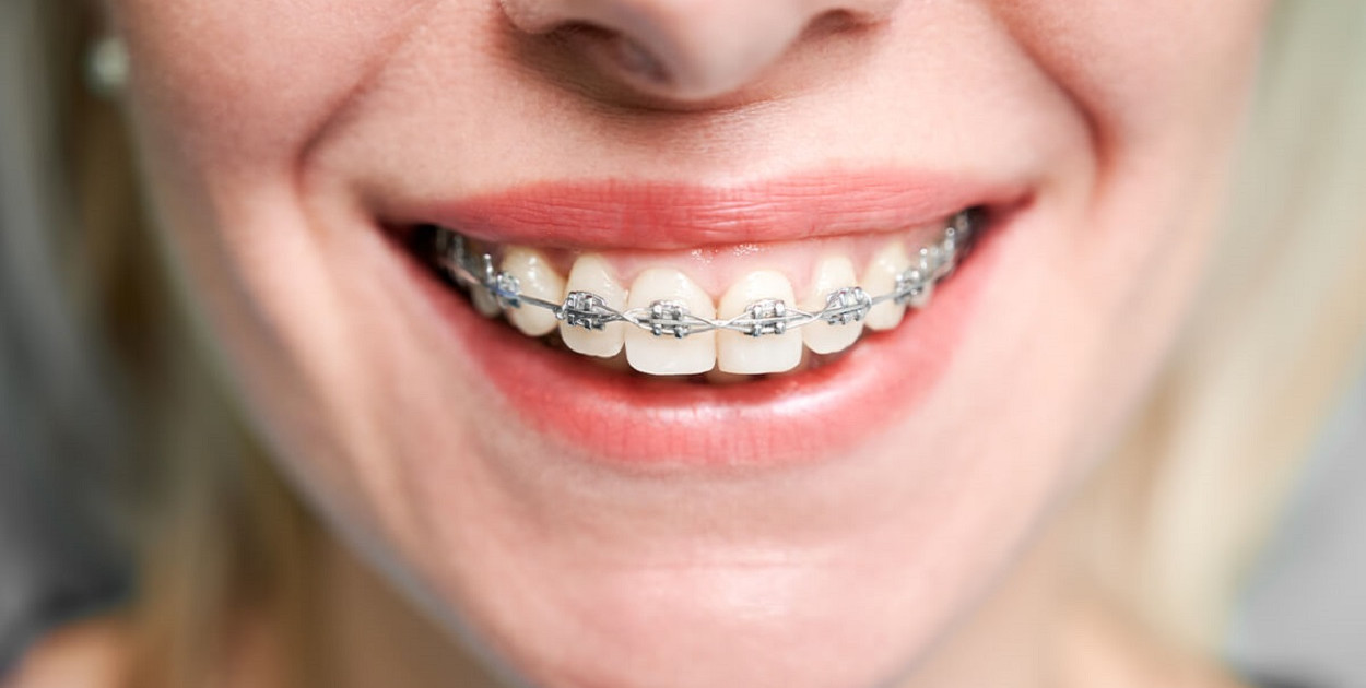 Piękny i zdrowy zgryz u dziecka - zadbaj o niego jak najwcześniej!